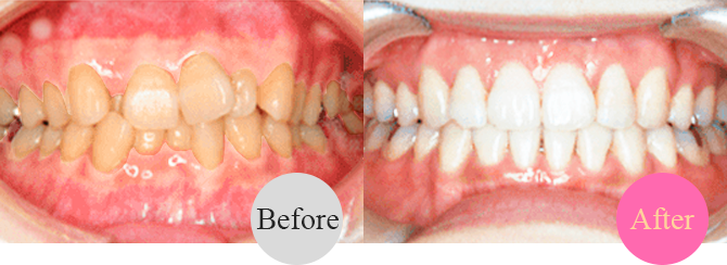 歯の黄ばみ（ホワイトニング併用可能）